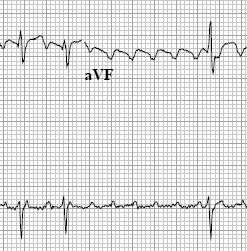 Typical Atrial Flutter Counterclockwise right atrial circuit Cavo-tricuspid isthmus dependent IVC CS Tricuspid Valve Atrial Flutter Challenging to rate control Typically requires high doses of nodal