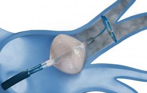 2. Freeze it: Cryoballoon Good tissue contact May reduce procedure
