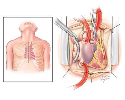 Concomitant Surgical Ablation Usually done with other heart surgery e.g. bypass surgery or mitral valve repair/replacement Open-chest surgery, with a heart-lung bypass.