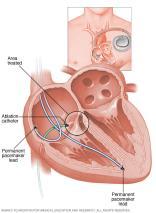 Electrophyisology: Continues to expand in scope and therapies Study of cardiac arrhythmias Medical management Pacemaker placement ICD implantation Implantable loop recorders Catheter ablation