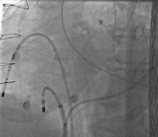 difficult to precisely keep track of catheter location during prolonged/complex ablations Electroanatomic mapping
