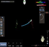 Using a mapping system to track catheters and make a
