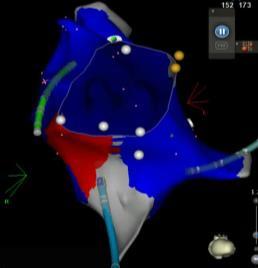 Propagation map showing atrial flutter Cavotricuspid