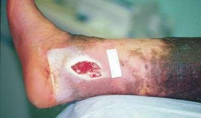 chronic wounds, such as pressure injuries, leg