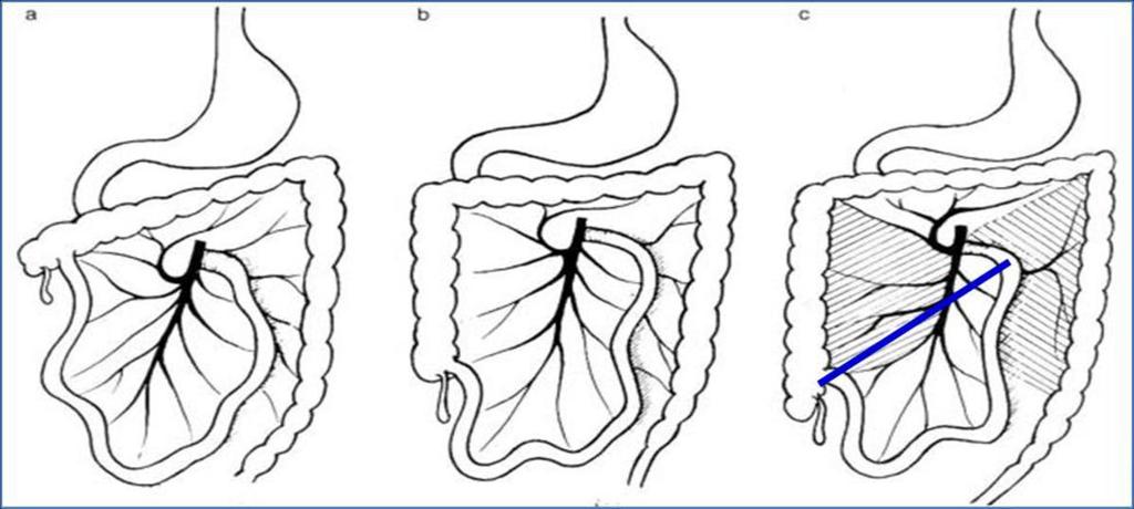 bowel obstruction upstream. Fig.