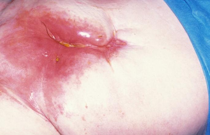 Wounds behaving badly Open Wound Mesh in wound Enteric contents Skin