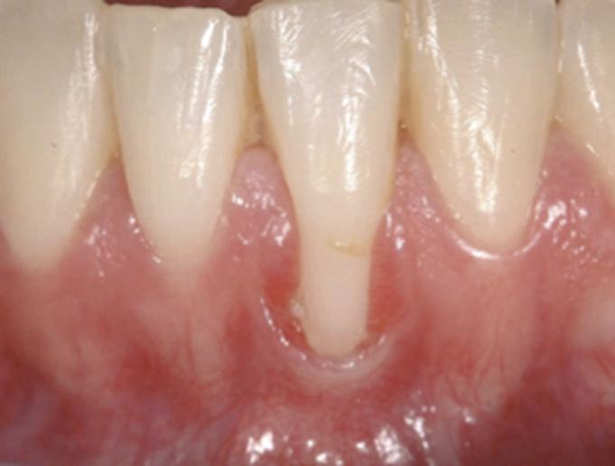 GR defects. 5 Miller Classification of Mucogingival Defects: Clinical Presentations All patients presented in this paper provided written or oral informed consent prior to treatment.