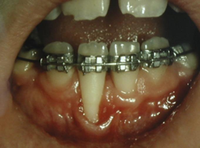 1), GR does not extend to or beyond the mucogingival junction, there is no loss of interdental bone or soft tissue present, and full root coverage can be anticipated. For Class II (Fig.