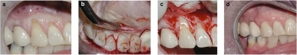 FIGURE 8 Outcome assessment for treating GR defects. FIGURE 9a Initial presentation of maxillary Miller Class I defects and restored non-carious cervical lesion on the canine.