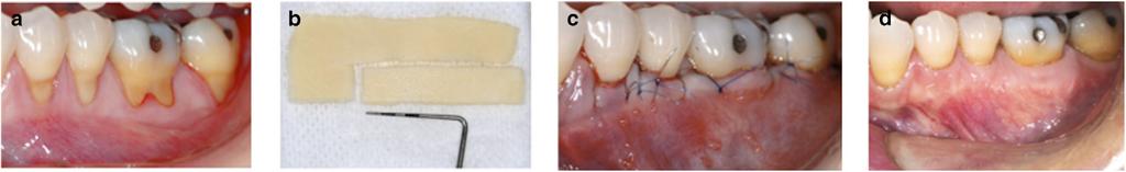 FIGURE 11a Initial presentation of mandibular Miller Class I and II GR defects on posterior teeth. 11b ADMG measured to defect dimensions. 11c CAF sutured.