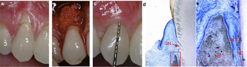 12b Tunneling procedure using anterior vertical access window. 12c Collagen matrix placed into prepared tunnel. 12d Clinical outcome at the 3-year follow-up.