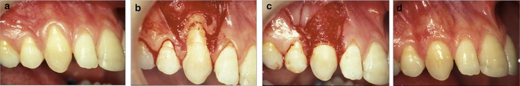 FIGURE 16a Initial presentation of maxillary Miller Class I GR defects. 16b Split-thickness flap elevated. 16c GTR procedure with freeze-dried bone allograft þ polylactic acid resorbable barrier.