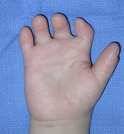 A blunted fourth metacarpal, with normal fifth