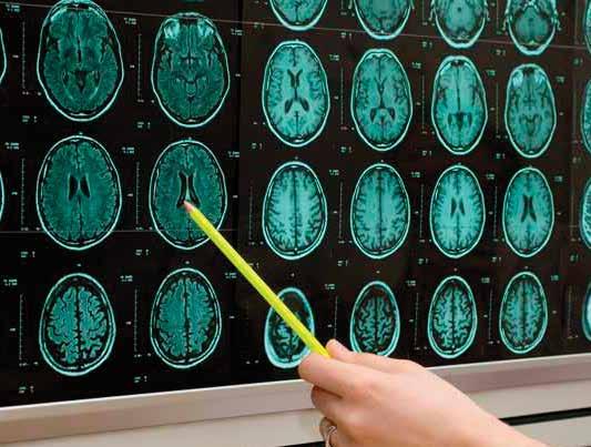 Kreipkitės į gydytoją dėl Jums tinkamo gydymo rekomendacijų ir kuo anksčiau pradėkite gydymą Dėl pasireiškiančių smegenų audinio pažaidų IS sergantiems pacientams dažniau nei sveikiems asmenims
