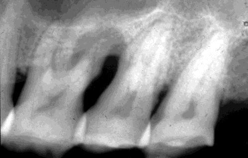 pulp and periradicular region and their treatment. What is Endodontic treatment?