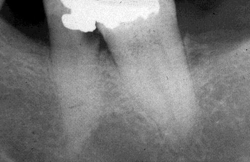 Resorption: Internal external Fractured tooth Crown, root ( vital/non-vital) Horizontal, vertical fracture Atypical facial pain American Association of Endodontists terminology Pulpal Diagnosis