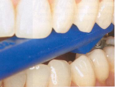 PERCUSSION TEST Tooth Slooth Used to assess cracked teeth and incomplete cuspal fractures PALPATION TEST Extraoral To detect swollen