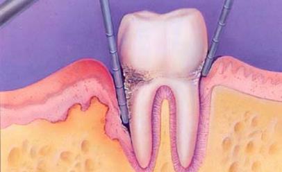 intensity PERIODONTAL PAIN May be well localized 
