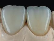Initial LiSi ceramics has vibrant and warm colour tones with an excellent fluorescence, similar to natural teeth, for very lifelike restorations under any light sources, even in the evening.