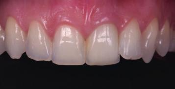 as for single tooth restorations and small bridges, in both the anterior and
