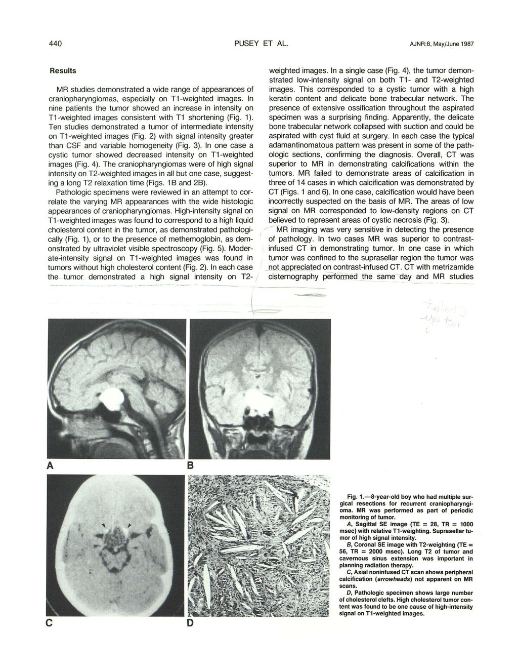 440 PUSEY ET L. JNR:8, May/June 1987 Results MR studies demonstrated a wide range of appearanes of raniopharyngiomas, espeially on T1-weighted images.