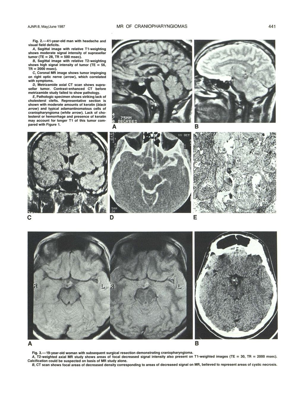 JNR:8, May/June 1987 MR OF CRNIOPHRYNGIOMS 441 Fig. 2.-41-year-old man with headahe and visual field defiits.