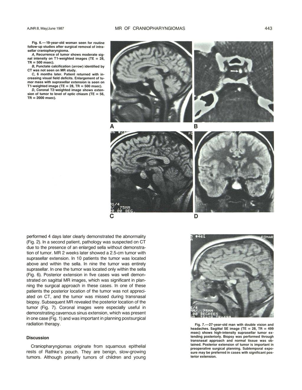 JNR :8, May/June 1987 MR OF CRNIOPHRYNGIOMS 443 Fig. 6.-19-year-old woman seen for routine follow-up studies after surgial removal of intrasellar raniopharyngioma.