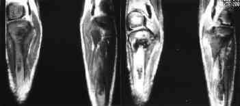 The T1-weighted image(tr 500 ms, TE 30 ms) demonstrates ill-defined area of low signal intensity involving both tibia.