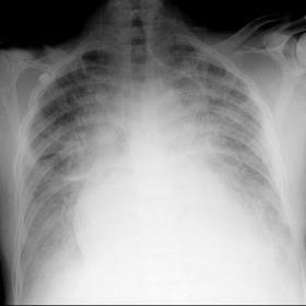 CXR Echocardiogram Cardiomegaly Pulmonary congestion