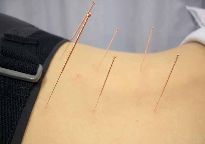 What you need to know about Acupuncture