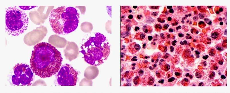 Myeloid/lymphoid neoplasms with eosinophilia Abnormalities of: PDGFRA, PDGFRB, or FGFR1 - Result from abnormal fusion gene encoding an abnormal tyrosine kinase, usually but not invariably with > 1500