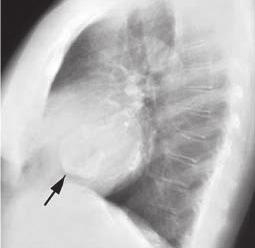2 pav. Šoninė krūtinės rentgenograma, dešiniajame prieširdyje stebimas kalcifikuotas darinys miksoma (pažymėta juoda rodykle) [1] 3 pav.