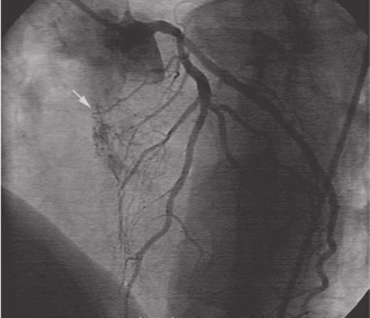 4 pav. Širdies angiografija, kairioji vainikinė arterija.
