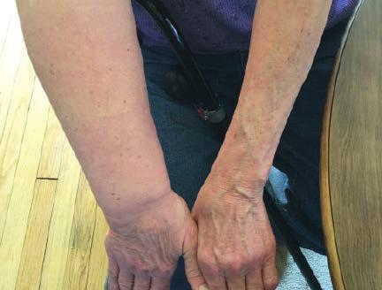 TYPES OF LYMPHEDEMA PRIMARY LYMPHEDEMA Primary lymphedema is often called congenital lymphedema, as it may be caused by congenital (hereditary) malformations of the lymphatic system.