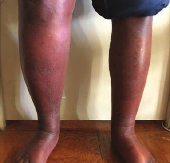 Some specific forms of primary lymphedema are: Milroy s disease (congenital lymphedema). This disorder begins in infancy and causes lymph nodes to form abnormally.