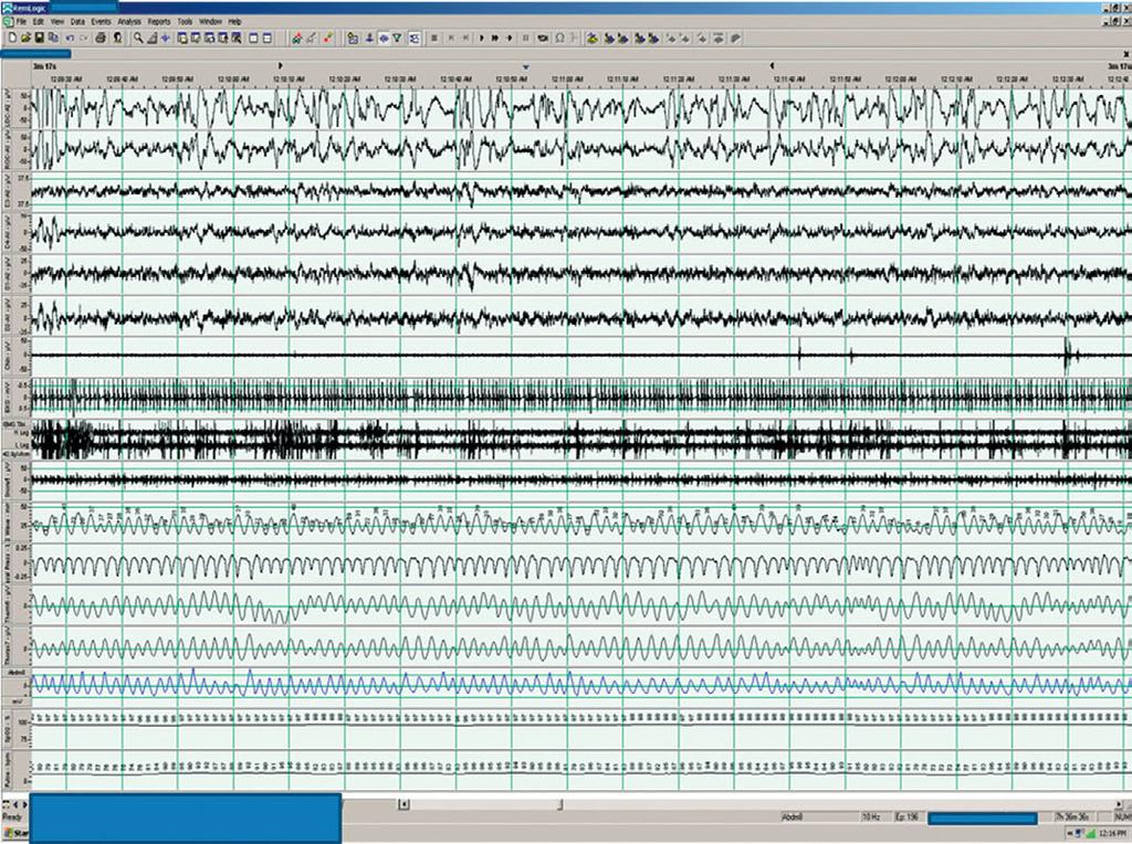 1 A 74-year-old man with severe ischemic cardiomyopathy and atrial fibrillation The following 3 minute polysomnogram (PSG) tracing was recorded in a 74-year-old man with severe ischemic