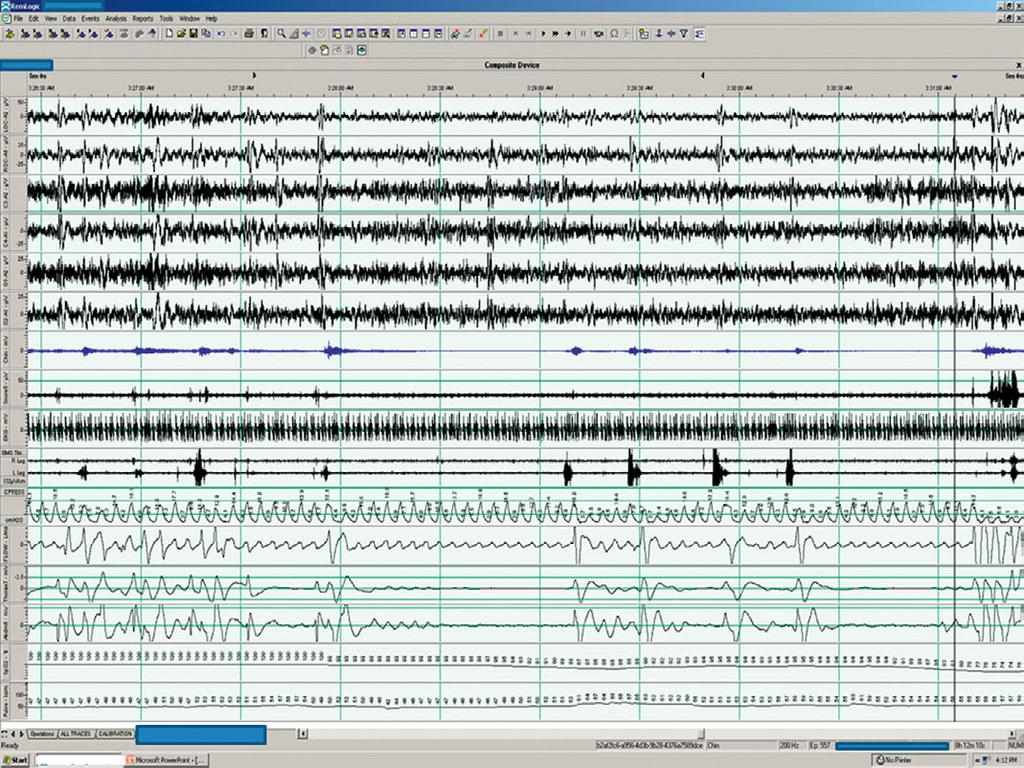 10 An 80-year-old man with heart failure and previously documented Cheyne Stokes breathing The following 5 minute PSG tracing was recorded during NREM sleep with the application of servo PAP