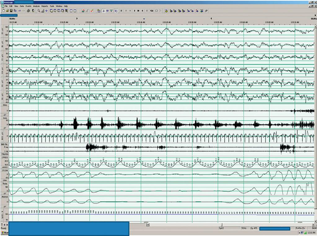 3 An 80-year-old man with severe heart failure and witnessed apnea awake and during sleep The following 60 second PSG tracing was recorded in an 80-year-old man with severe heart failure and