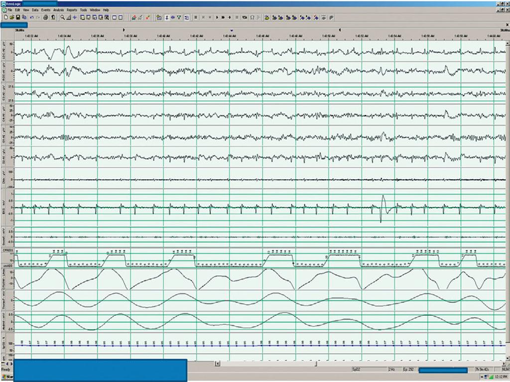 5 A 52-year-old man being treated for sleep-related hypoventilation A 30 second PSG epoch is shown that was recorded in a 52- year-old man being treated for sleep-related hypoventilation with bilevel