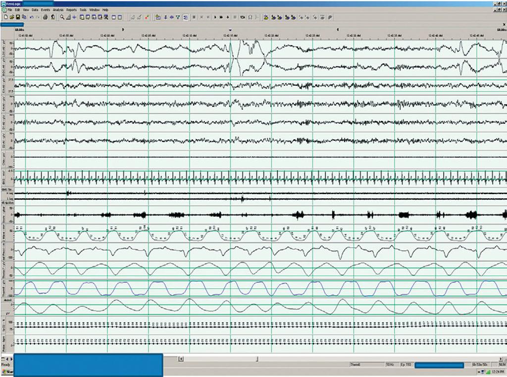 6 An 81-year-old obese woman with a history of snoring Displayed below is a 60 second PSG epoch of supine sleep recorded in an 81-year-old woman with a body mass index (BMI) of 31 and a history of