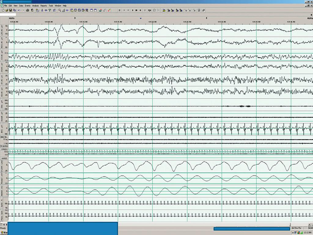 8 A 57-year-old woman with moderate obstructive sleep apnea The following is a 30 second epoch from a nocturnal PSG performed in a 57-year-old woman with moderate OSA undergoing titration with CPAP.