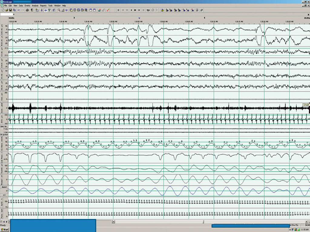 9 A 57-year-old woman with potential obstructive sleep apnea The following is a 60 second PSG tracing from a 57-year-old woman being studied to assess for OSA. Her awake baseline ETco 2 was 38 mmhg.