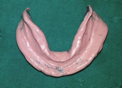 Materials and Method A 60-year-old male patient presented with the chief complaint of difficulty in mastication, loosening of upper and lower dentures, and poor esthetics for the past 4-5 years.