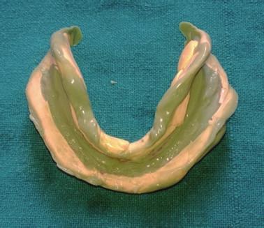 In the sixth technique, mandibular secondary impression was made using elastomeric impression materials.