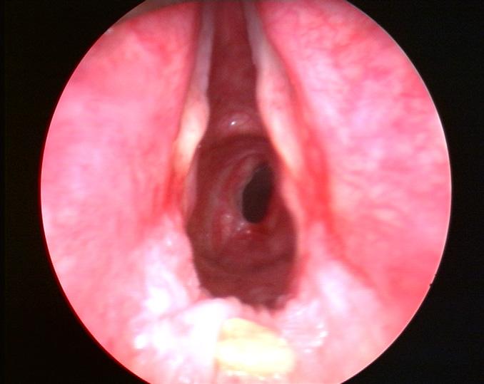 Presentation of tracheal stenosis Presents weeks to months after intubation Slowly progressive dyspnoea Cough and wheeze easily mistaken for asthma Inspiratory stridor Recurrent pneumonias Table 2