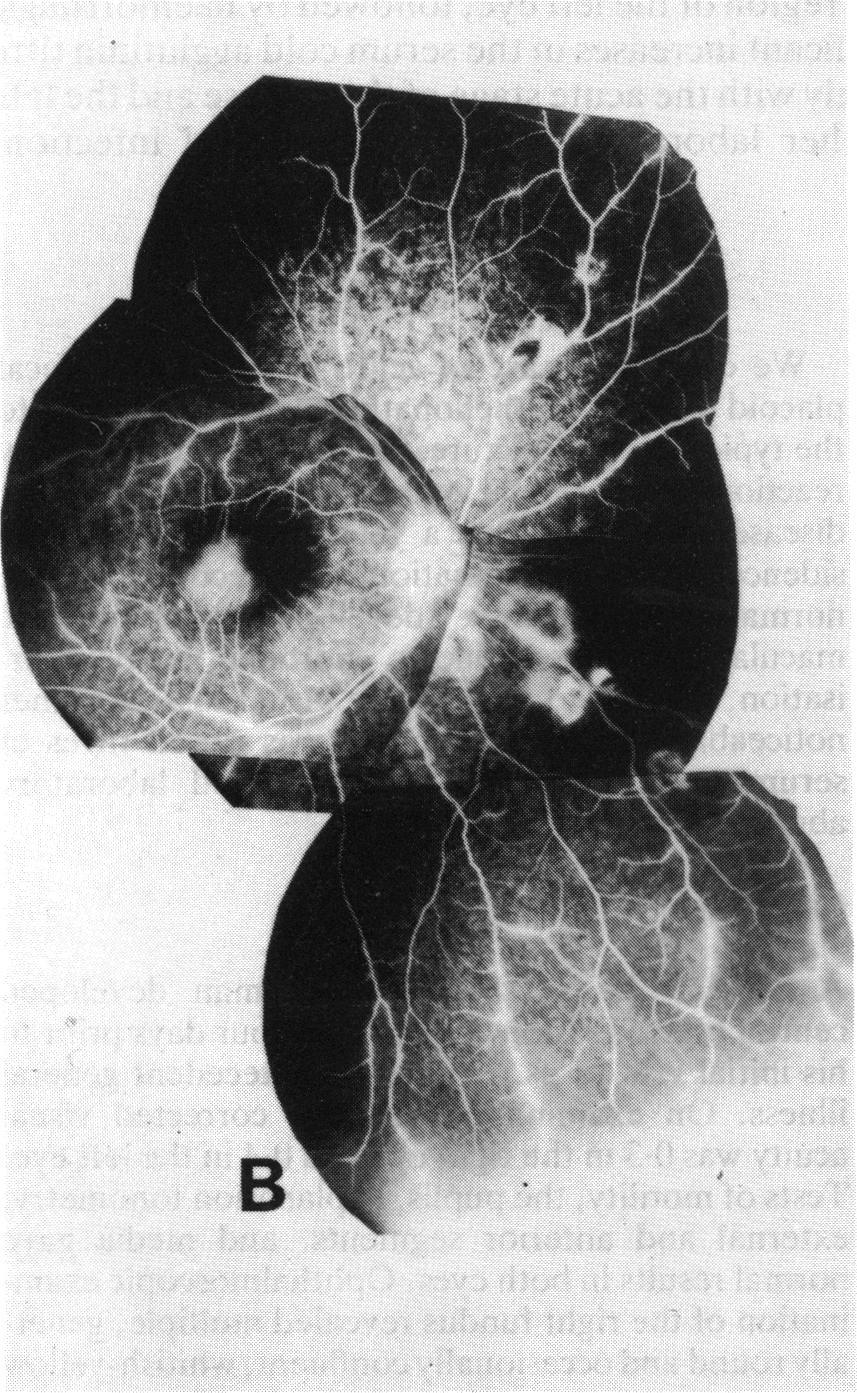 (A) Early phase ofthe angiogram, showing blockages ofthe background choroidalfluorescence in the