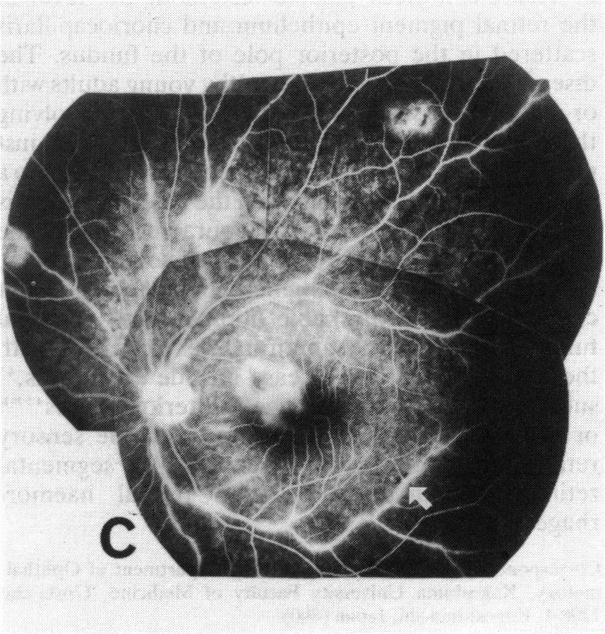 (B) Right eye, (C) left eye, late phase ofthe angiogram, showing hyperfluorescence in the placoid