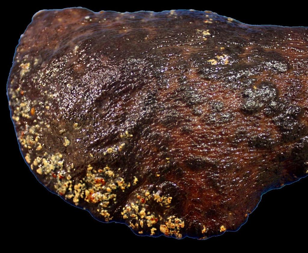 colour Hemosiderin brown-gold colour What deposits