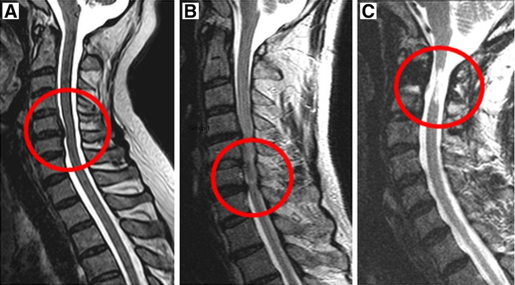 1588 GAIT ANALYSIS IN CERVICAL MYELOPATHY, Kim METHODS Participants The study involved patients treated by cervical laminoplasty or laminectomy for CSM between January 2003 and August 2007 at the