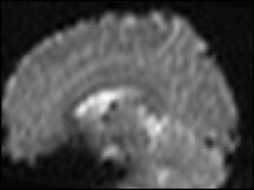 Functional MRI (fmri) Uses echo planar imaging (EPI) for fast acquisition of T2*-weighted images.